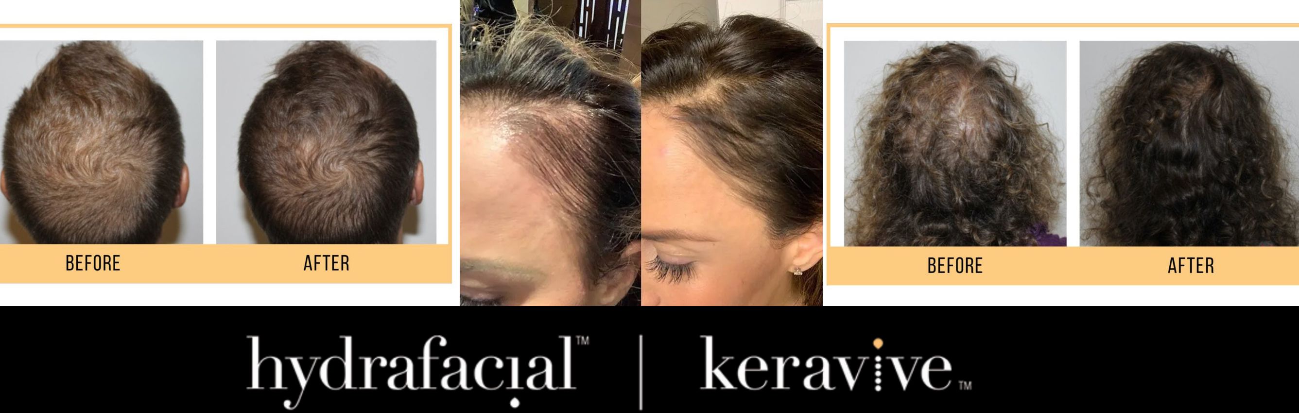 Keravive | Soins des cheveux | OM Signature | Esthétique Médical